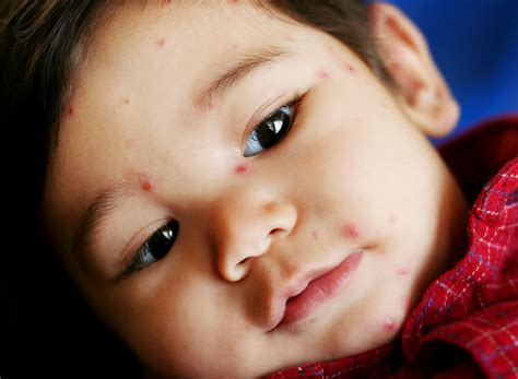 Baby Rashes Types Symptoms And More