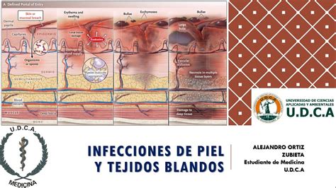 Infección De Piel Y Tejidos Blandos Alejandro Ortiz Youtube