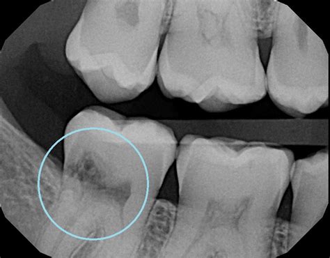 Why Do I Need X Rays — Lakes Region Dental Center