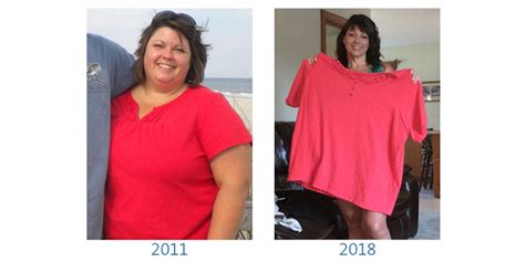 Gastric Bypass Before And After