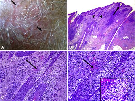 Erosive Pustular Dermatosis Of The Scalp A Neutrophilic Folliculitis