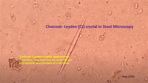 Cristais De Charcot Leyden