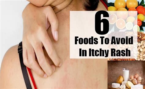 And itchy or burning skin. 6 Foods To Avoid In Itchy Rash | Search Home Remedy