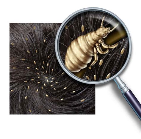 Types Of Lice And Common Head Lice Symptoms Lice Clinics Of America