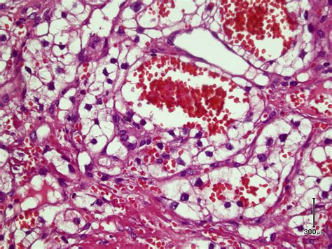 Cutaneous Metastasis Of Renal Cell Carcinoma A Case Report