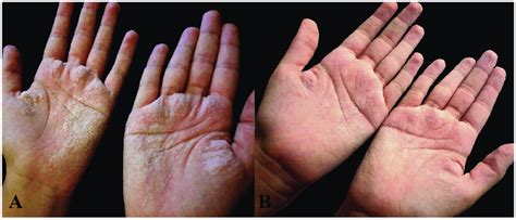 A Hypopigmentation In The Palmar Regions After Contact With Water