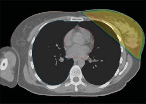 Scielo Brasil Incidental Irradiation Of Internal Mammary Lymph