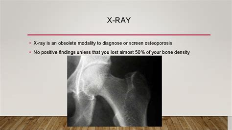 Osteoporosis Student Led Seminar Definitions Osteoporosis Characterized By