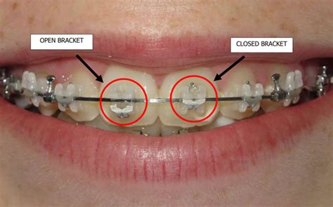 Orthodontic Problems Specialist Orthodontics Treatment Mackay
