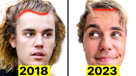 Did Justin Bieber Have A Hair Transplant Youtube