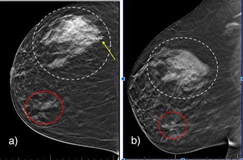 Right Breast Diagnostic Mammogram Cc View A And Ml View B Show An