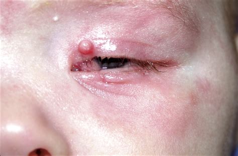 Eyelid Fibrous Hamartoma With Conjunctival Angioma In An Infant