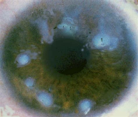 Ocular Pathology Salzmanns Nodular Degeneration Of The Cornea
