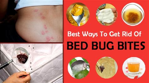 How To Treat Bed Bug Bites With Home Remedy Youtube