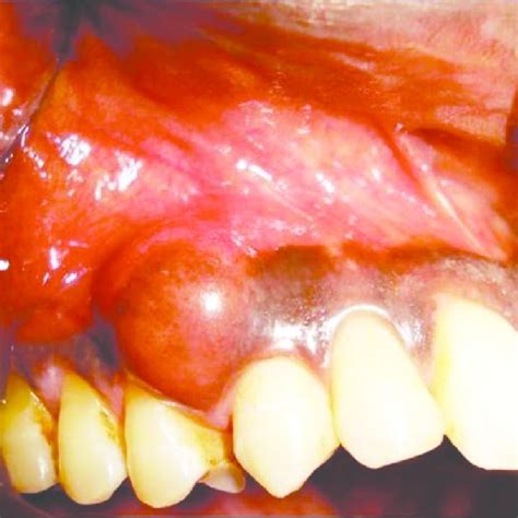 Pdf Extraosseous Ameloblastoma Of Maxillary Gingiva A Rare Case