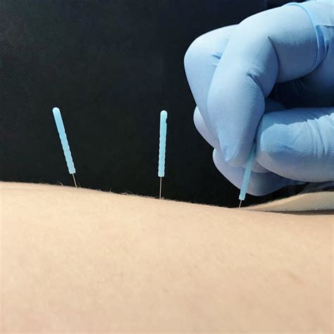 an overview of dry needling — complete game physical therapy