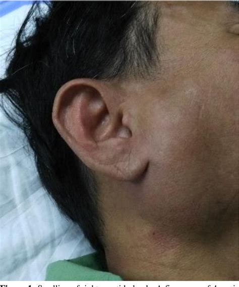 Figure 1 From Transient Unilateral Parotid Gland Swelling Following
