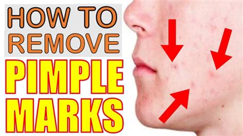How To Remove Pimple Marks Scars And Dark Spots Naturally Epic Natural