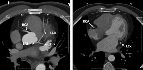 Identifying Coronary Artery Calcification On Non Gated Computed Tomography Scans Protocol