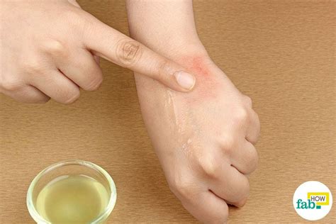 Home Remedies For Rashes Fab How