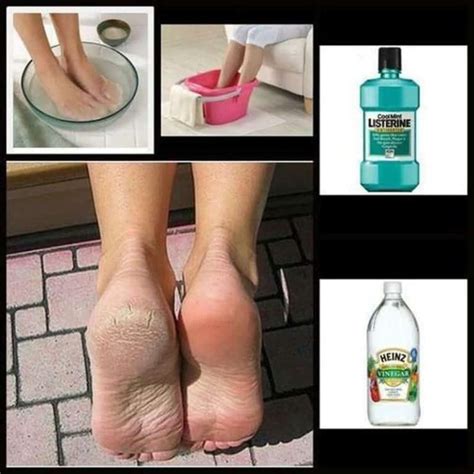 Diy Listerine Foot Soak Recipe Heal Cracked Heels At Home Artofit