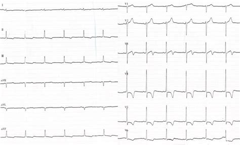 12 Lead Ecg Recording Of The First Patient Leads I Ii Iii Avr Avl