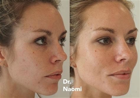 Dermal Fillers For Girl In Her 20s Before And After Best Clinic