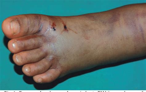 Snake Bite Is A Neglected Topical Disease But Snake Vernom Saves Life
