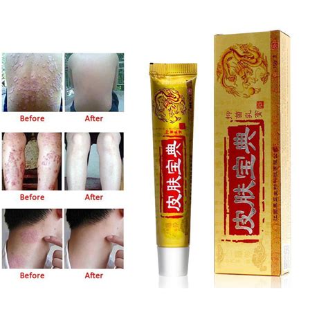 Buy Chinese Medicine Cream Psoriasis Dermatitis Eczema Pruritus Skin