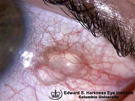 Conjunctival Cyst Vagelos College Of Physicians And Surgeons