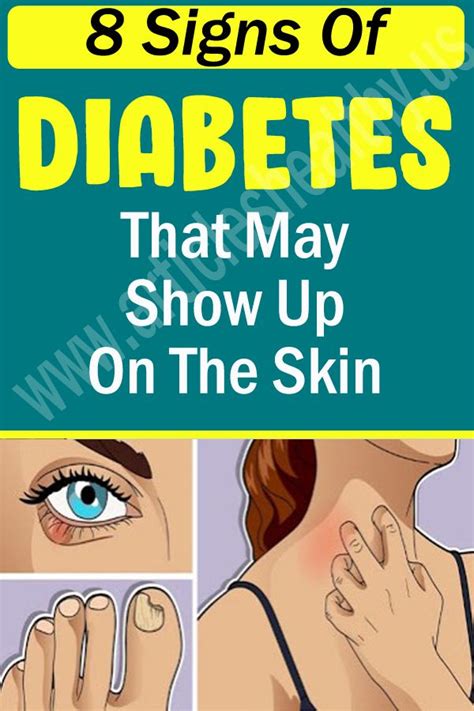 8 Signs Of Diabetes That May Show Up On The Skin Holistic Health