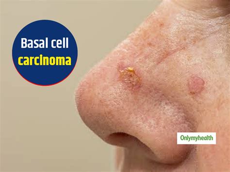 Warning Signs Of Basal Cell Carcinoma