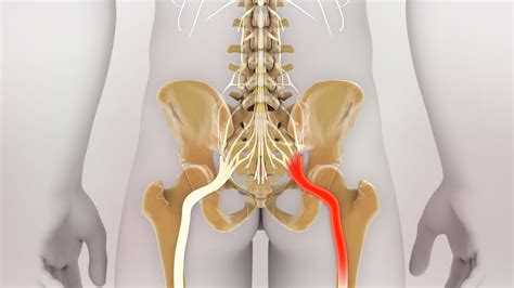 Piriformis Syndrome And How Active Release Techniques Art Works Lincoln Park Chiropractic