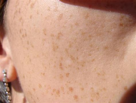 Brown Spots On Face Causes Treatment Prevention Pictures Healthmd