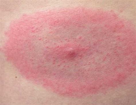 Healthoollyme Disease Rash Pictures Atlas Of Rashes Associated With