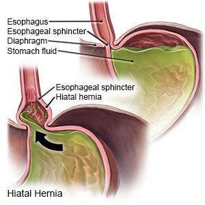 Collect, curate and comment on your files. Hiatal Hernia - What You Need to Know