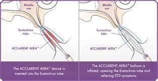 How much does an eustachian tube balloon dilation cost? Pin on ENT