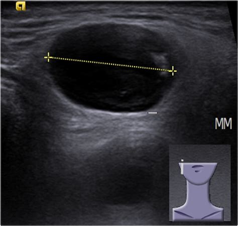 Primary Parotid Gland Lymphoma Pitfalls In The Use Of Ultrasound