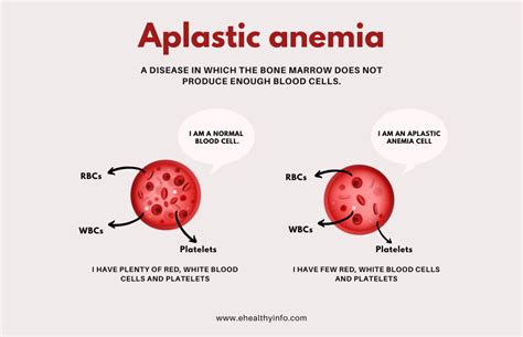 Aplastic Anemia E Healthy Info