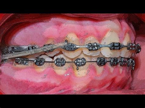 INTERMAXILLARY ELASTICS Tom Nasiopoulos Orthodontist YouTube