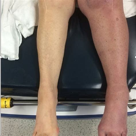 Discoloration Of The Left Leg In The Setting Of Pcd Pcd Phlegmasia