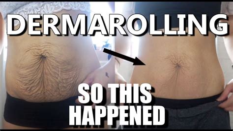 I Tried Dermarolling My Saggy Skin And This Happened Astonishing Results Youtube