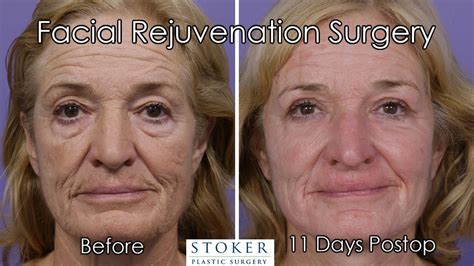 Facelift Los Angeles One Of The Best Plastic Surgeons In Los Angeles Reveals Results Days