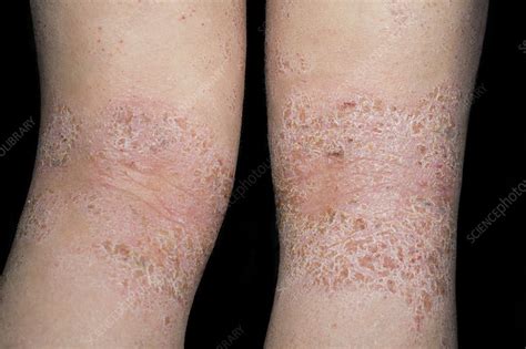 Atopic Dermatitis Pictures On Back Nacionefimera