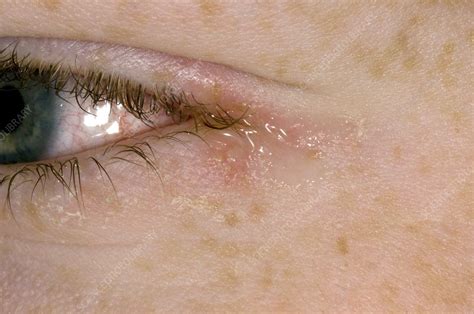 Eye Herpes Herpes Symptoms Causes Types Treatments Post Oak Er