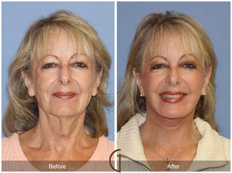 Facelift Seventies Before And After Photos Patient 28 Dr Kevin Sadati