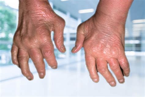 Psoriatic Arthritis Types Symptoms Causes Prevention And Treatment