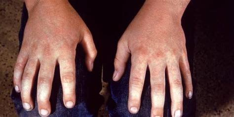 Four Rash Patterns Common In Adults With Parvovirus Infection 2