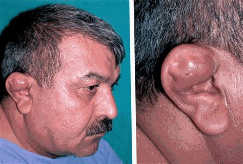 P67 Recurrent Auricular Pseudocsyt Treatment With Curettage And