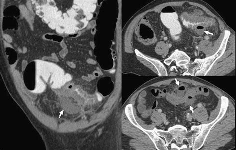 Complicated Sigmoid Diverticulitis With Two Paracolic Abscesses White